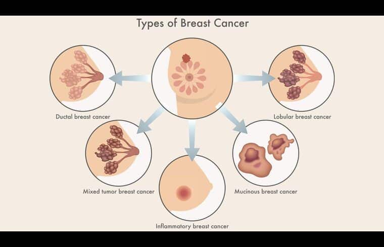 What Is Breast Cancer