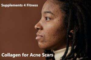 Collagen for Acne Scars