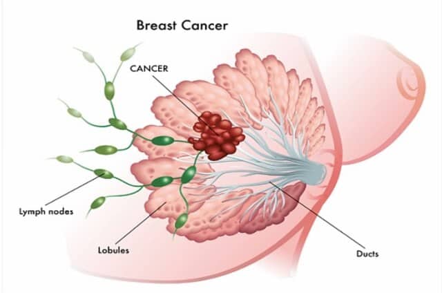 How Does Breast Cancer Develop