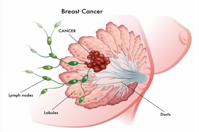 how-does-breast-cancer-develop