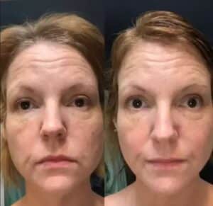 Eelhoe Collagen Boost Before & After