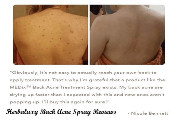 Herbaluxy Back Acne Spray Reviews