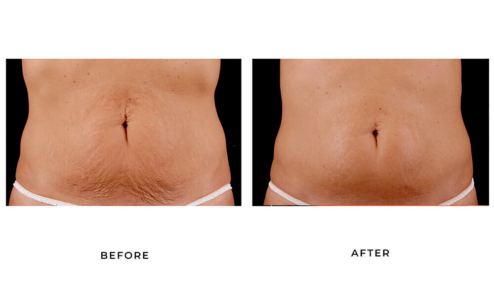 Vibro Sculpt Before And After Results