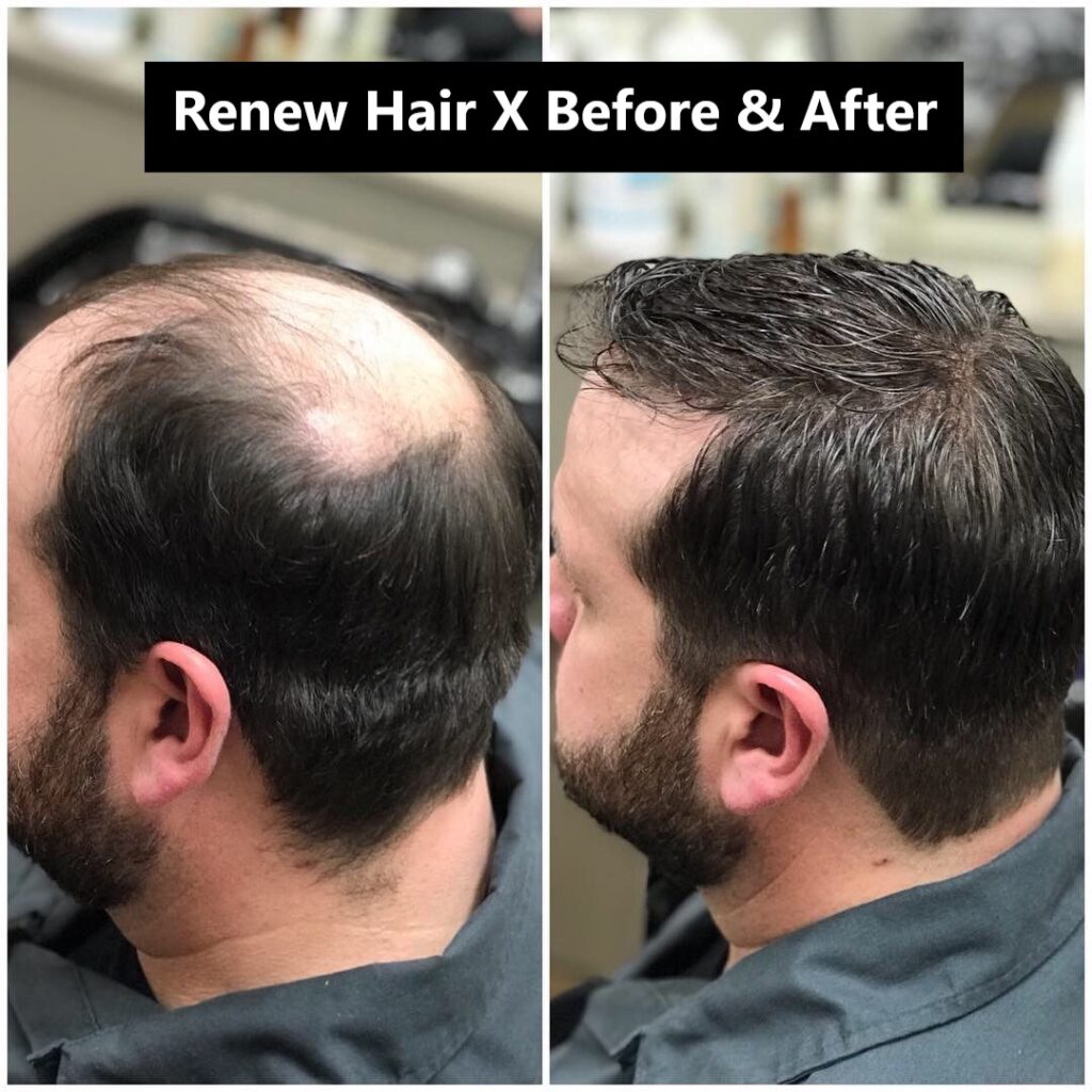Renew Hair X Before And After