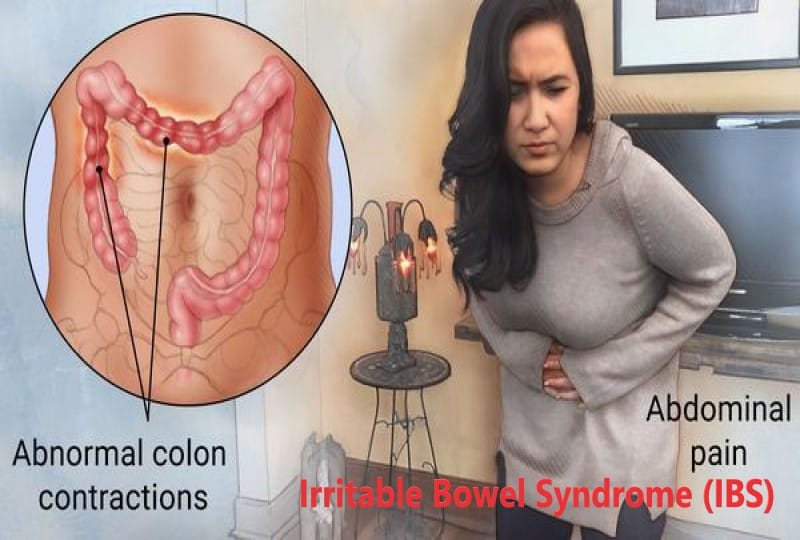 Irritable Bowel Syndrome (IBS)