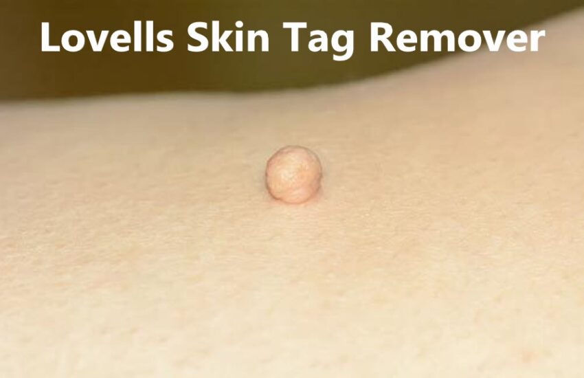Lovells Skin Tag Remover