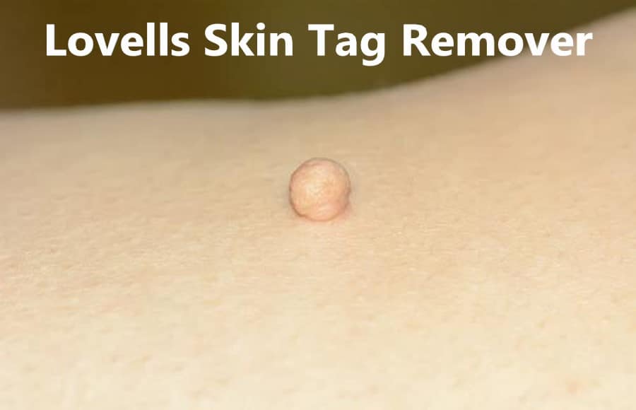 Lovells Skin Tag Remover