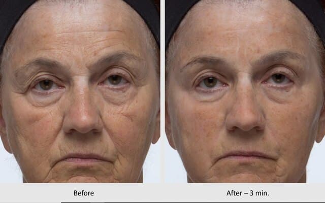 Dr. Denese Wrinkle Lost Before & After