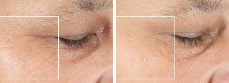 Nadove Micro Glow Facial Before And After