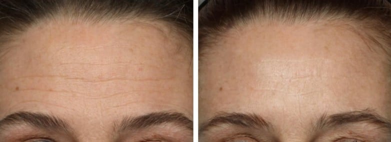 Nadove Micro Glow Facial Before And After